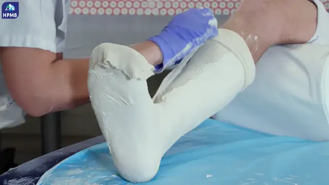 04 Attelle platree posterieur cheville